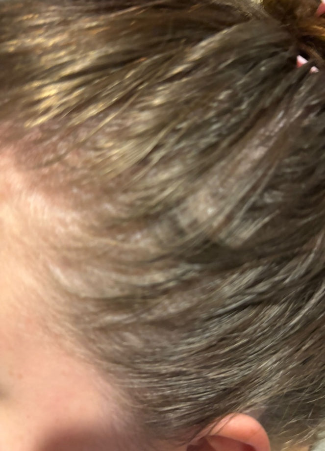 Close-up of a thinning hairline