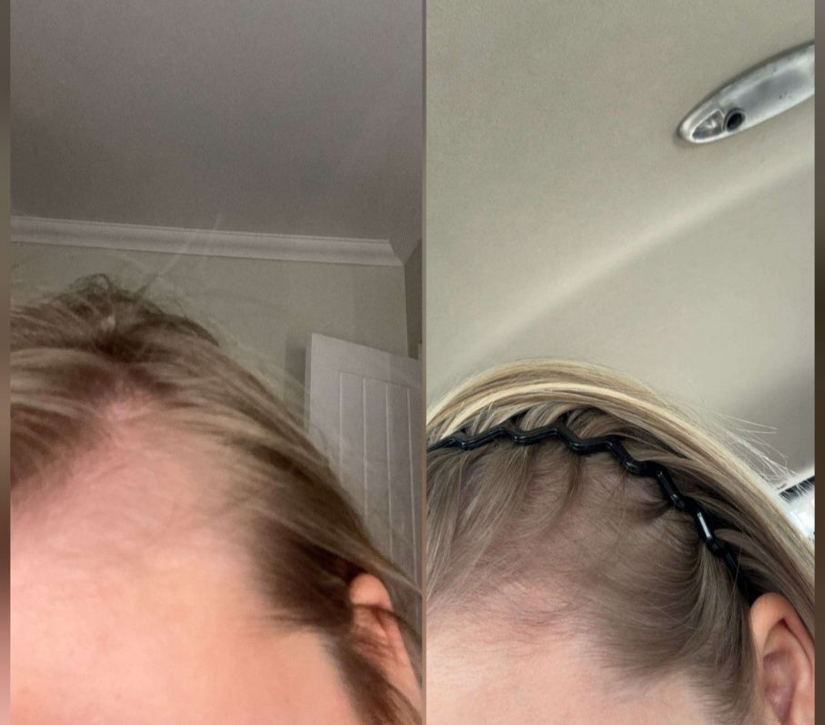 Close-up of hair thinning on the scalp
