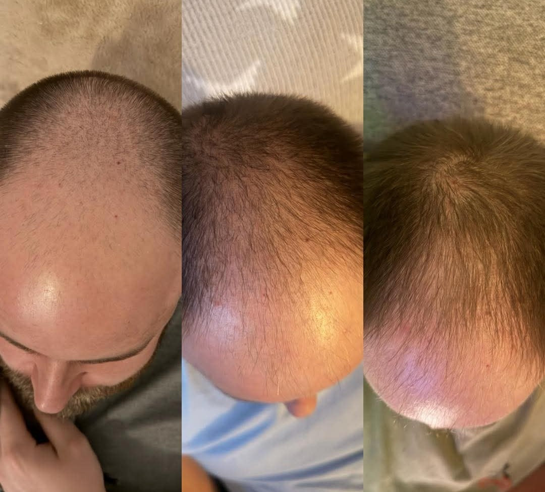 Crown hair comparison photographs