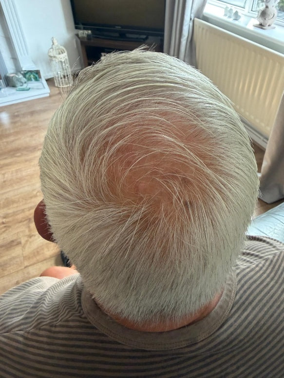 Hair thinning at the crown