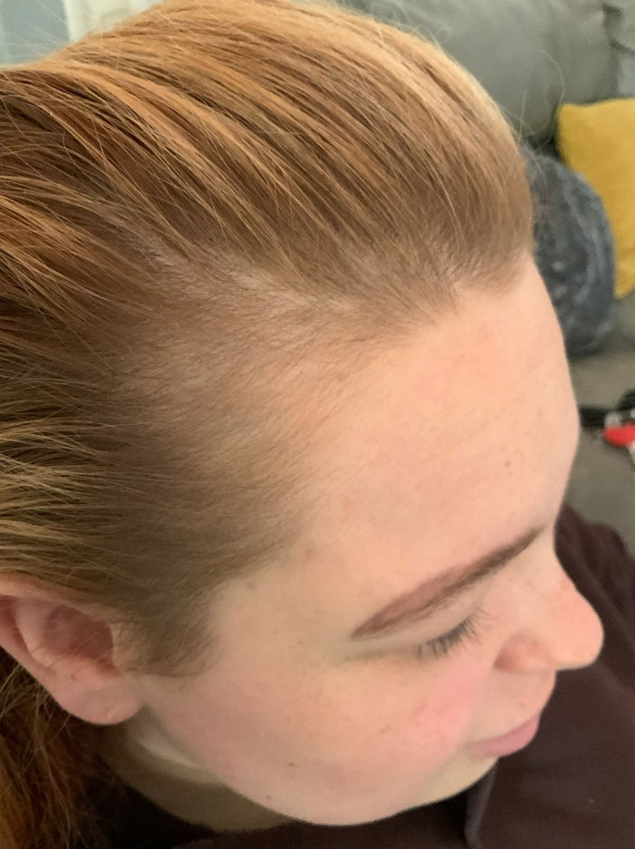 Photograph of a hairline